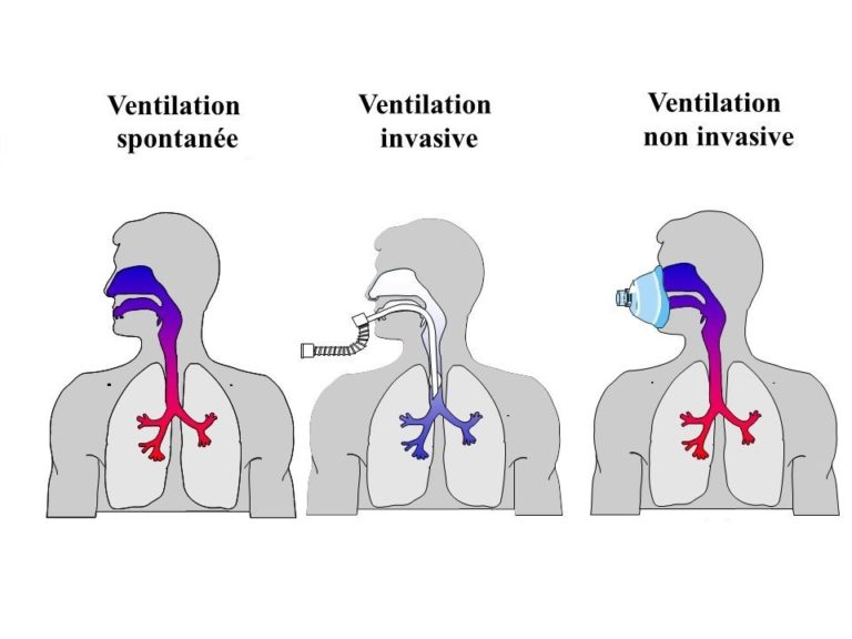 pandorma-qu-est-ce-que-la-ventilation-non-invasive